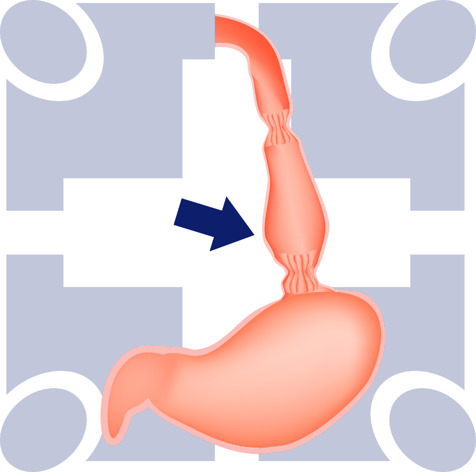 What Is Peroral Endoscopic Myotomy Clipart (960x952), Png Download