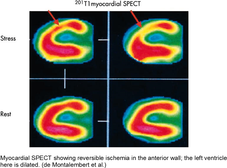 Evidence Of Myocardial Ischemia/infarction In Children - Ventricle Clipart (976x693), Png Download