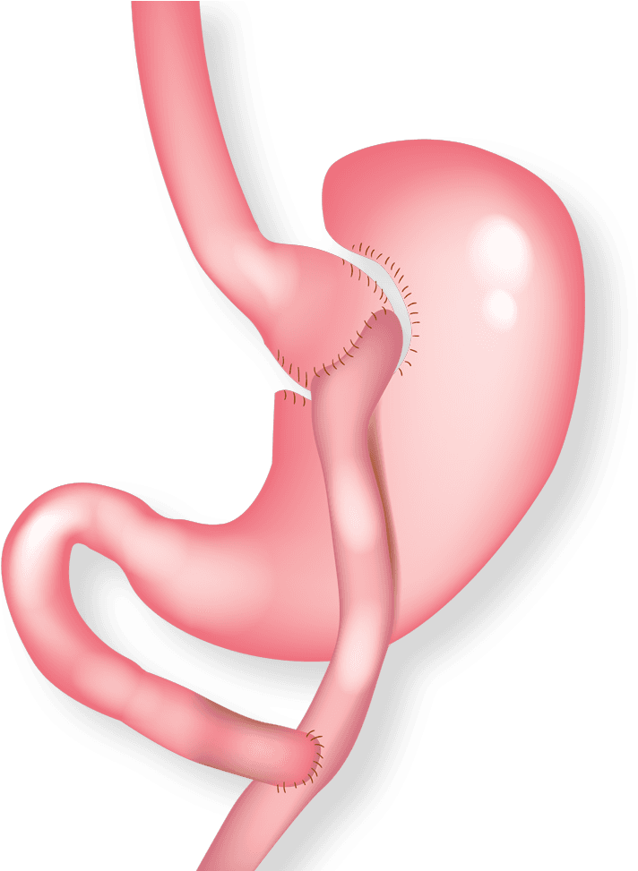 Gastric Bypass - Gastric Bypass Surgery Clipart (773x972), Png Download