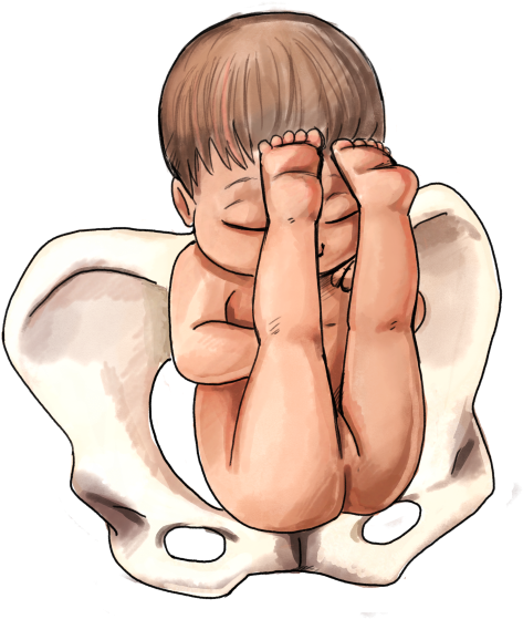 Frank Breech Baby - Extended Breech Clipart (500x647), Png Download