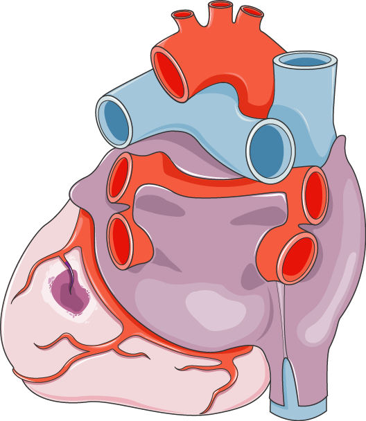 Infarctus Du Myocarde - Schéma D Un Infarctus Clipart (528x608), Png Download