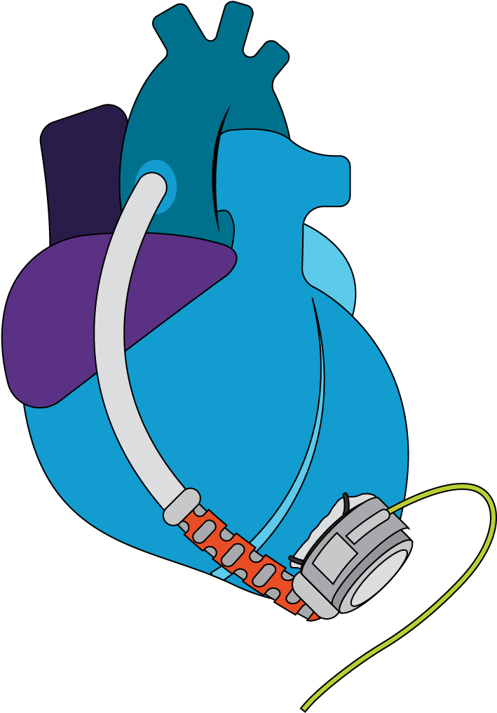 Example Of A Continuous Flow Lvad - Ventricular Assist Device Clipart (756x1046), Png Download