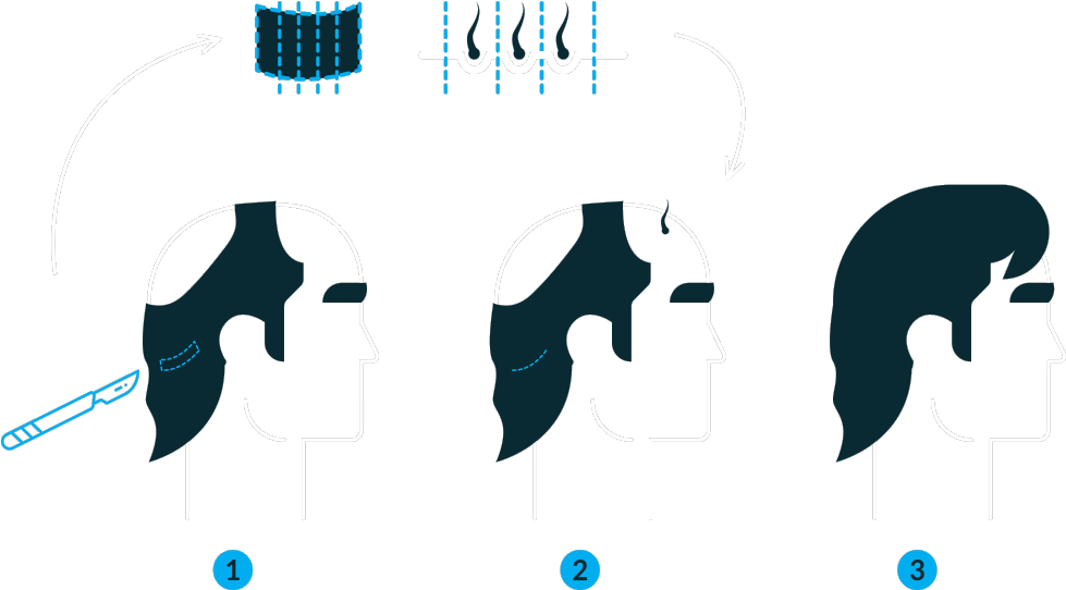 Follicular Unit Grafting Clipart (980x640), Png Download