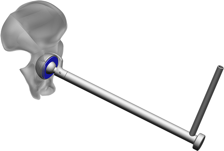 Erweitert1 - Endocon - Produkte - Hueftpfannenschneider - Plunger Clipart (800x600), Png Download