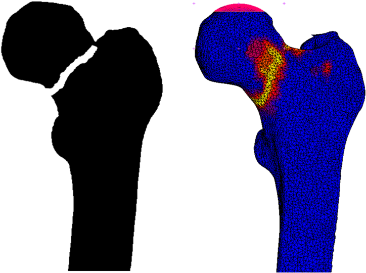 Example Of Femoral Fracture Prediction - Radboud University Medical Center Clipart (783x549), Png Download