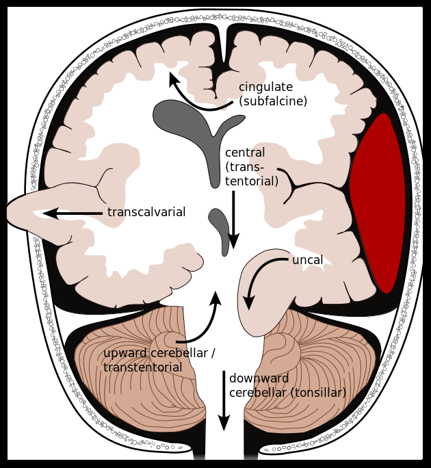 Neurology Review - Types Of Brain Herniation Clipart (630x684), Png Download