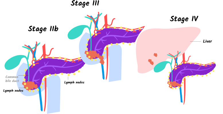 Illustration Of Stages Iib, Iii, And Iv Of Pancreatic Clipart (778x400), Png Download