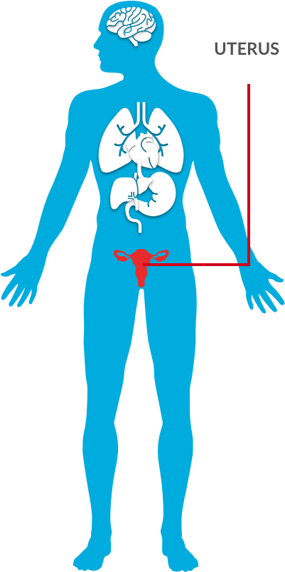 Robotic Assisted Hysterectomy Clipart (447x848), Png Download