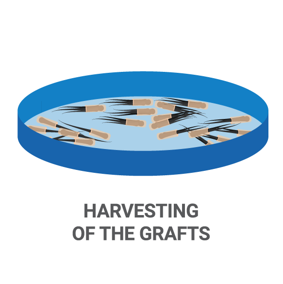 Beard Transplant Procedure Clipart (583x585), Png Download