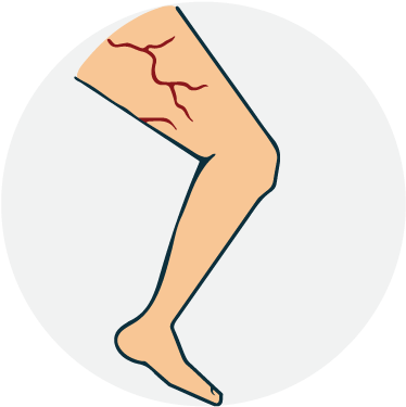 Varicose Vein Clipart (842x595), Png Download