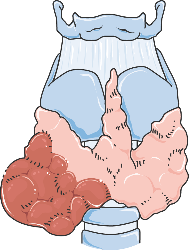 Cancer De La Thyroïde Clipart (612x809), Png Download
