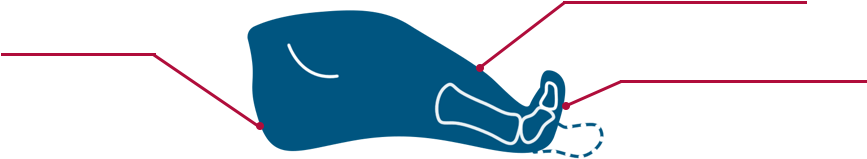 Bone Spur Removal » Clipart (1007x334), Png Download