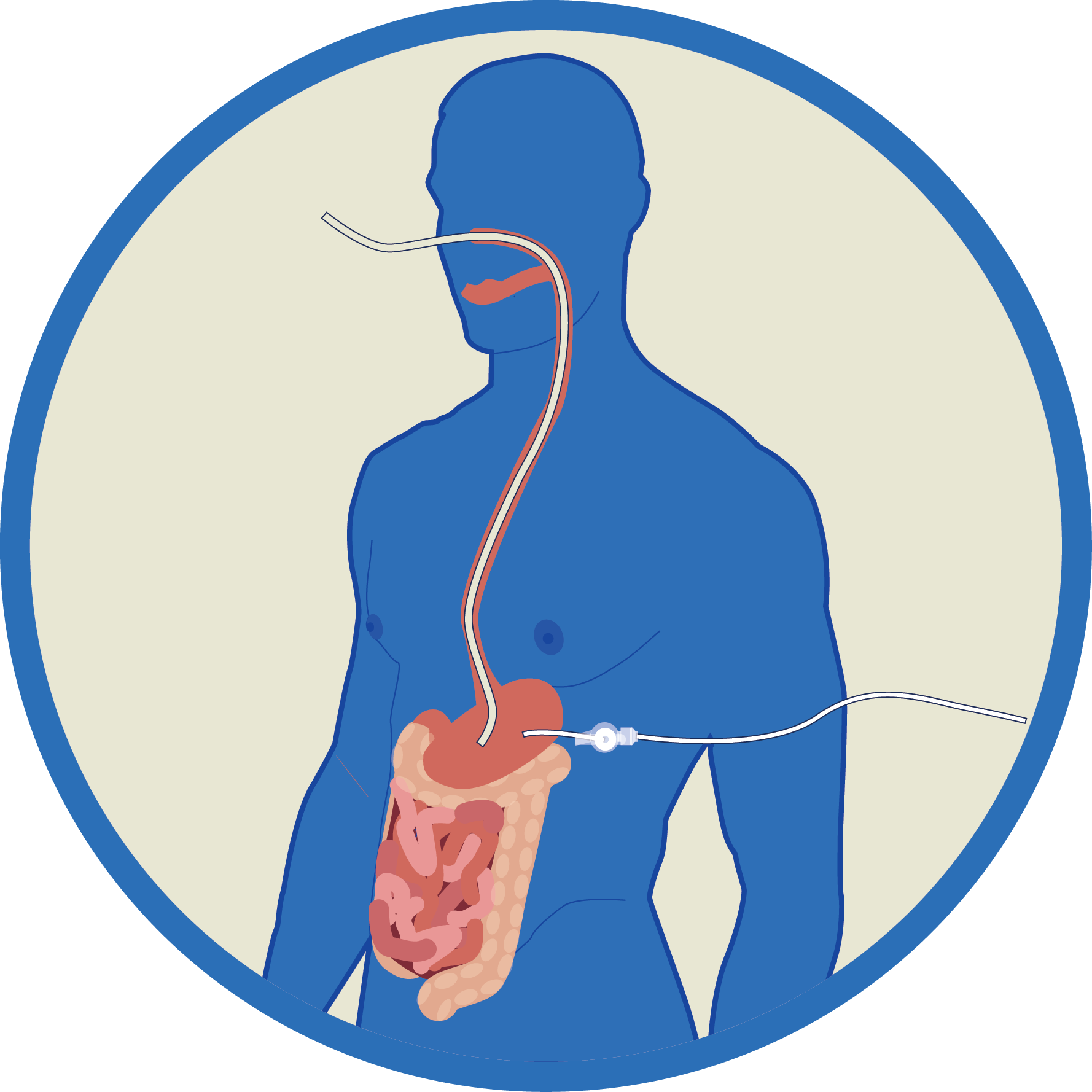Enteral Tube Feeding Nasogastric , Nasojejunal (nj), Clipart (1778x1778), Png Download