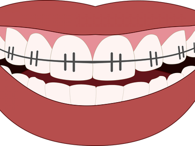 Tools Clipart Orthodontic - Png Download (640x480), Png Download
