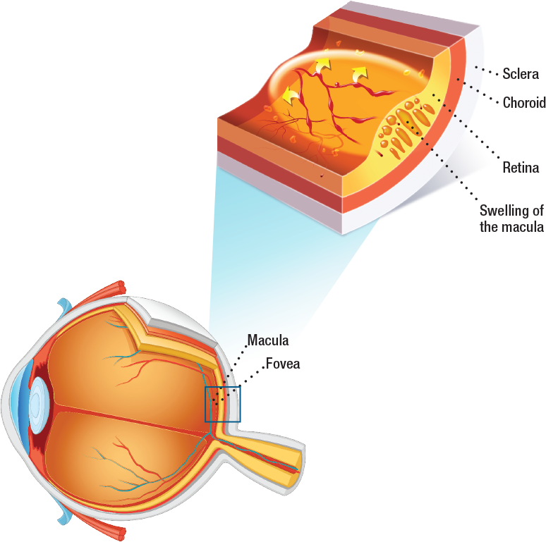 Photo Of A Retina With Diabetic Macular Edema Clipart (774x769), Png Download