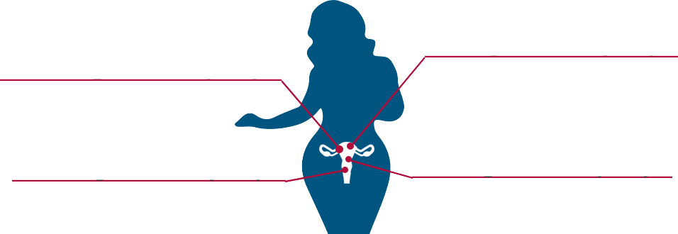 Second Degree Uterine Prolapse » Clipart (956x330), Png Download