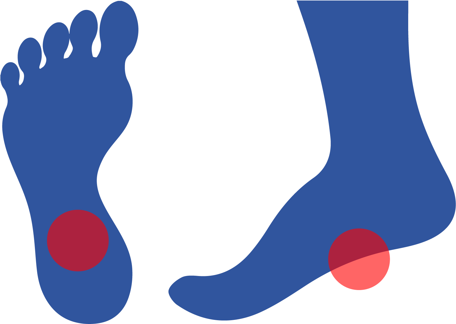 Plantar Fasciitis Is Caused By Inflammation Of A Thick Clipart (1667x1667), Png Download