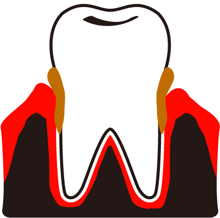 Dental Plaque Calculus Periodontal Hospital View All Clipart (640x480), Png Download