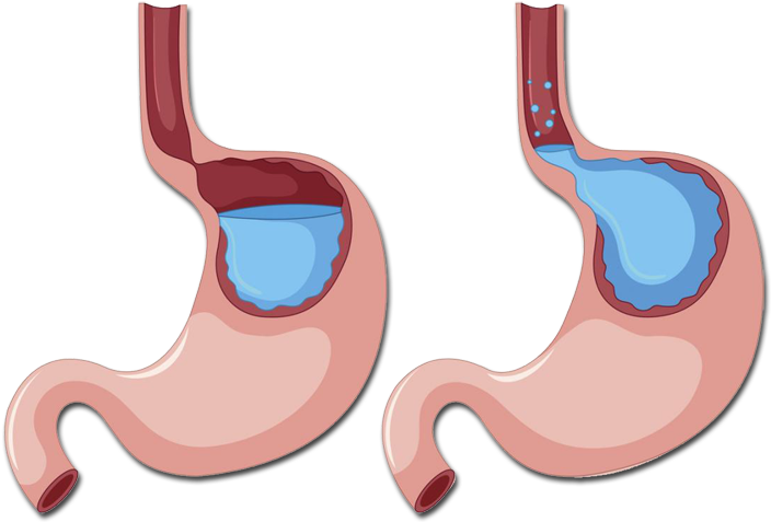 Doença Do Refluxo Gastroesofágico Clipart (709x483), Png Download