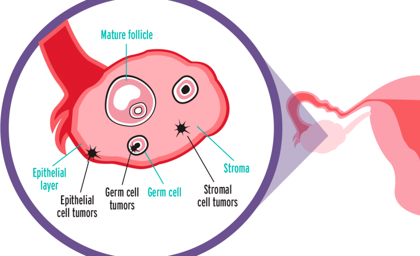 Knowing These Ovarian Cancer Facts Could Save Your - Epithelial Ovarian Cancer Types Clipart (820x500), Png Download