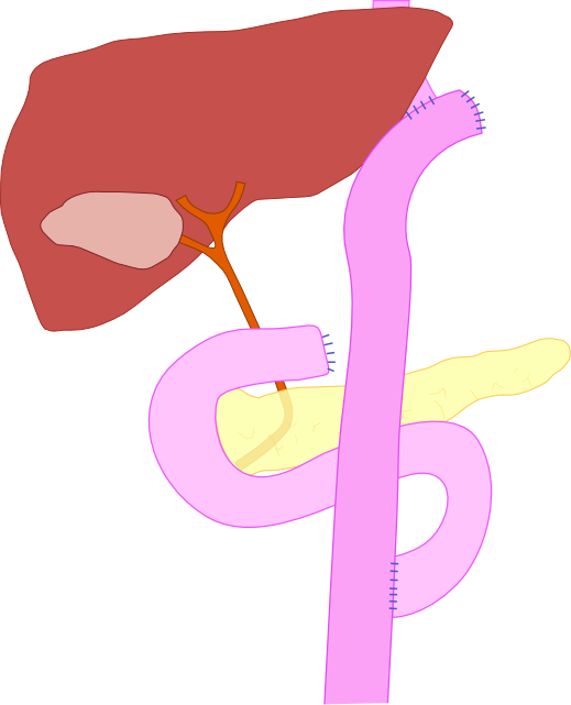 Total Gastrectomy With Roux En Y " - Roux En Y Gastrectomy Clipart (519x641), Png Download