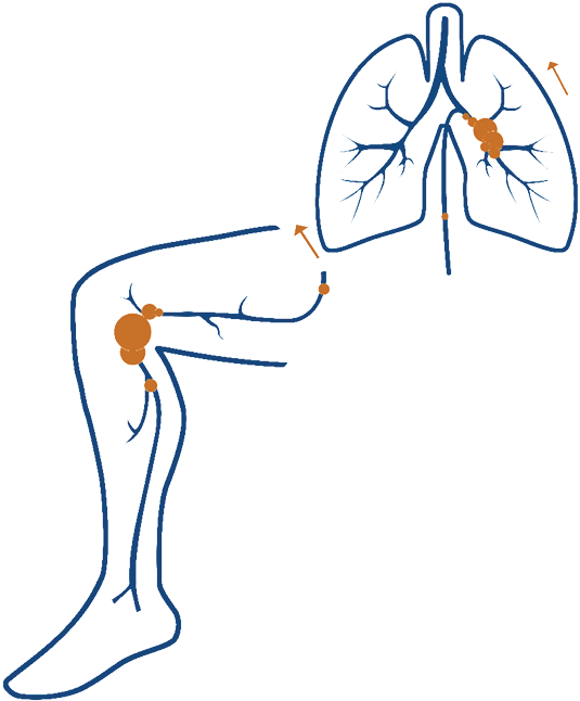 What Are Dvt And Pe Clipart (554x656), Png Download