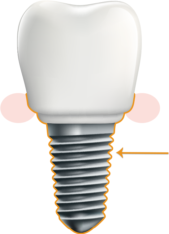 Periodontal Implant - Illustration Clipart (558x764), Png Download