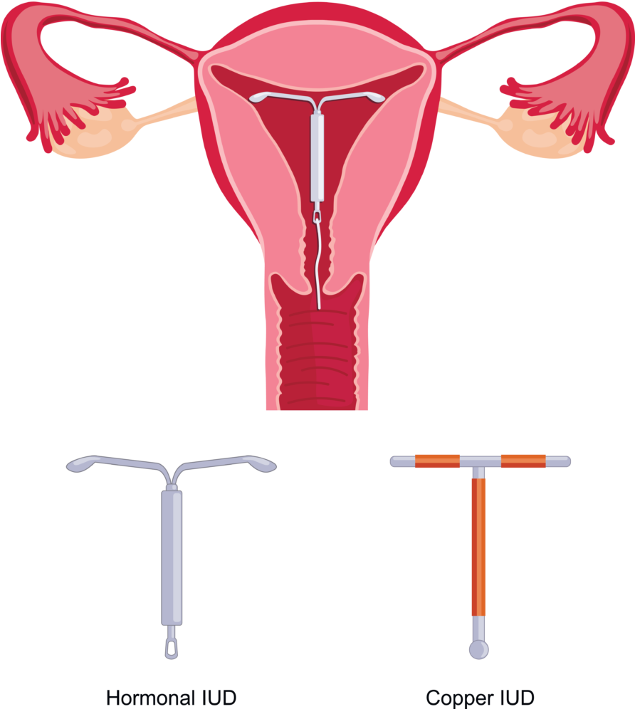Iud Colorado Springs - Artificial Insemination In Humans Clipart (891x1024), Png Download