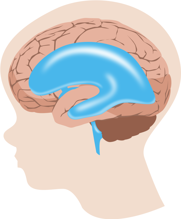 Hydrocephalus Is Most Often Treated By Surgically Inserting - Hydrocephalus Transparent Clipart (768x867), Png Download