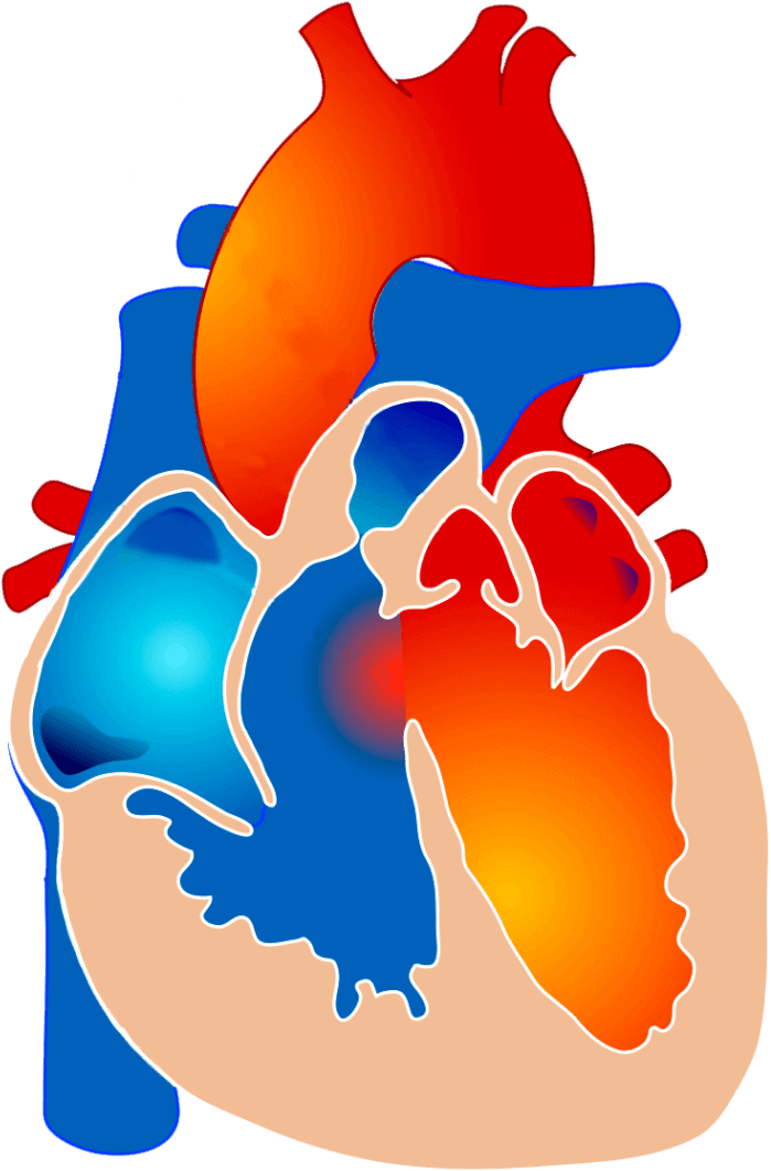 2000px Tetralogy Of Fallot It - Prove Tetralogy Of Fallot Clipart (768x1081), Png Download