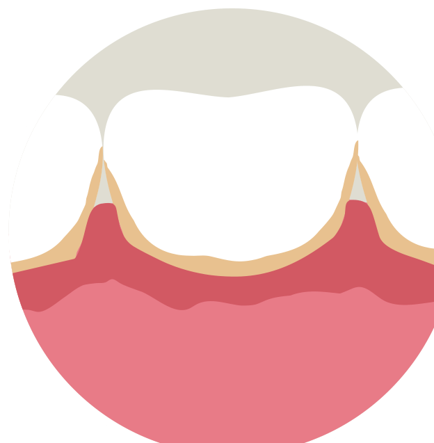 Bleeding Gums Illustration Clipart (1018x840), Png Download