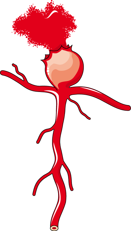 Download The Image - Intracranial Berry Aneurysm Clipart (421x741), Png Download
