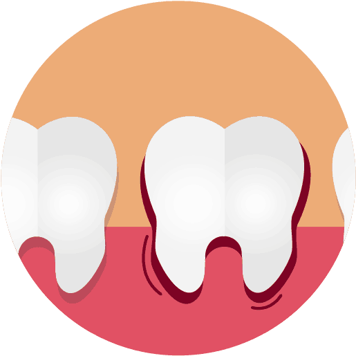 Swollen Gums Due To Gingivitis Graphic Clipart (626x626), Png Download