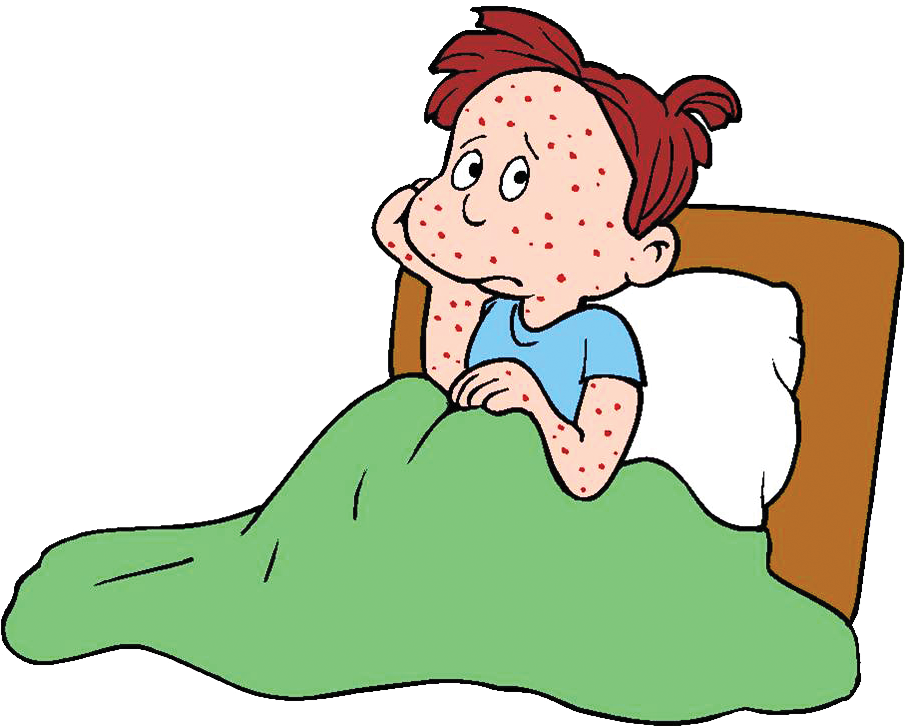 How To Deal With - Chicken Pox Clipart - Png Download (904x734), Png Download