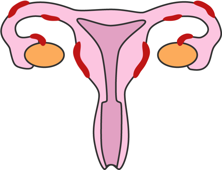 Endometriosis V2 Clipart (800x800), Png Download
