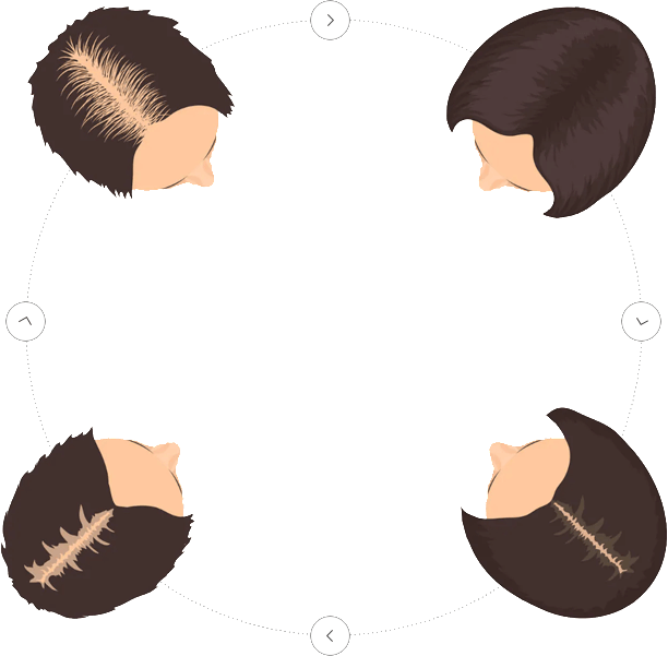 Women Hair Loss Stage Clipart (612x601), Png Download