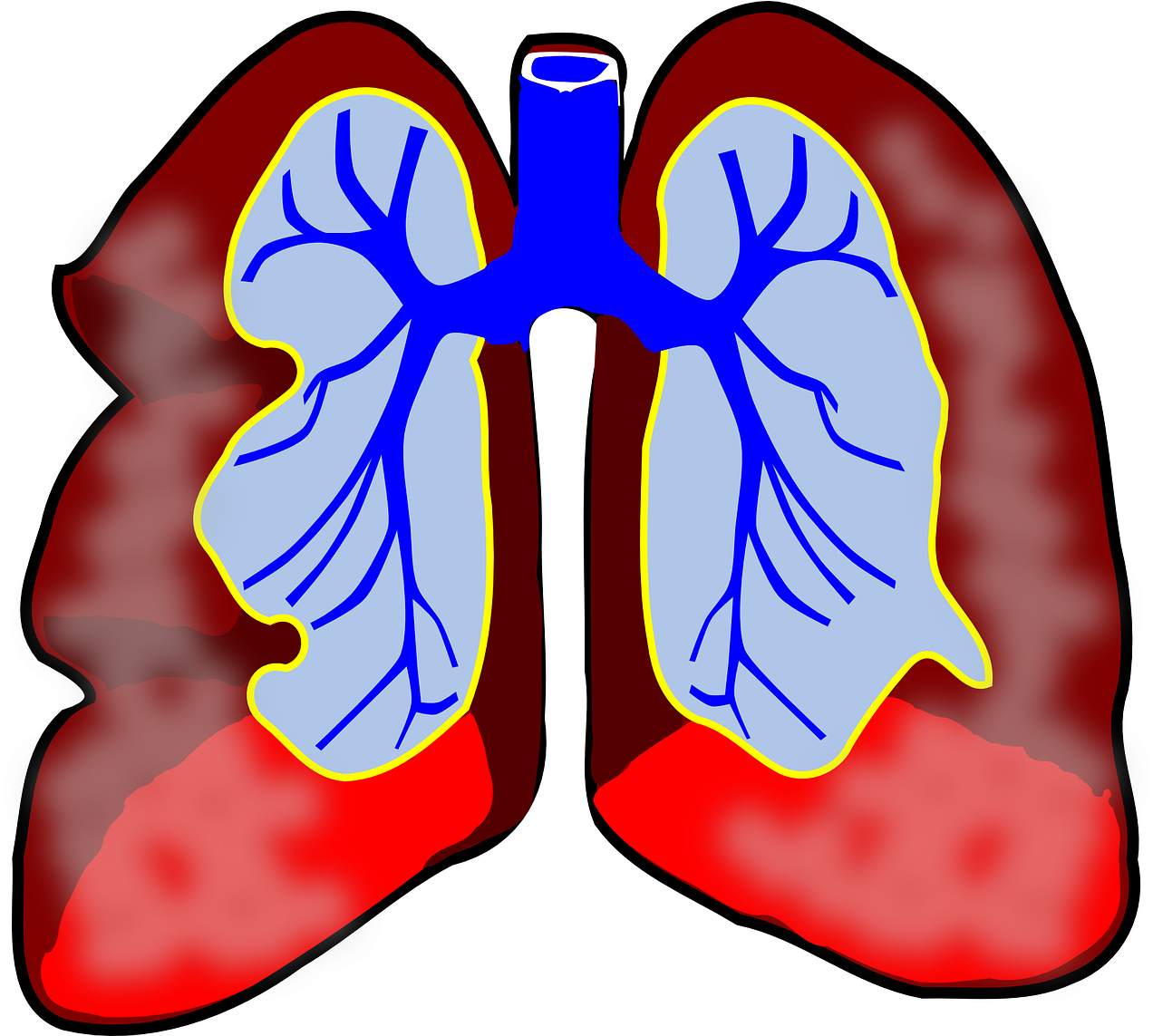 What Is Bronchitis Omaha Urgent Care - Lungs Clip Art - Png Download (807x720), Png Download