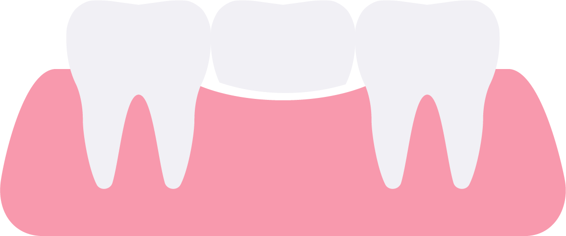 Dental Bridge Clipart (1156x482), Png Download