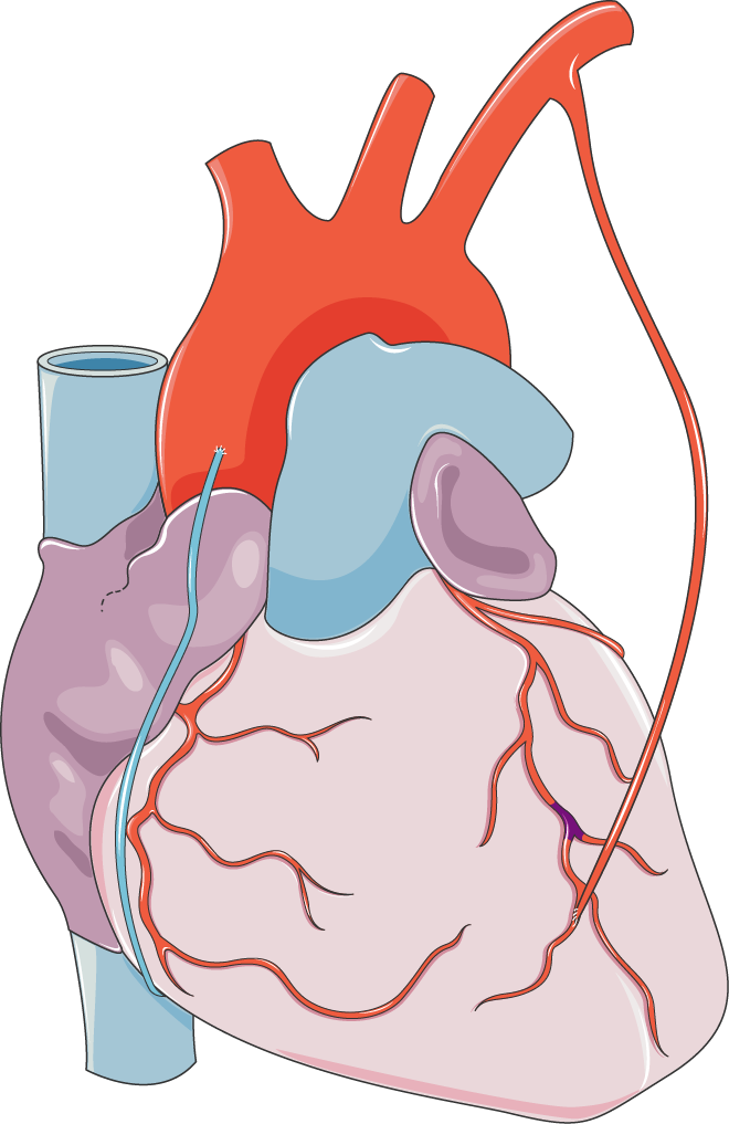 Coronary Heart Disease Bypass Clipart (660x1017), Png Download