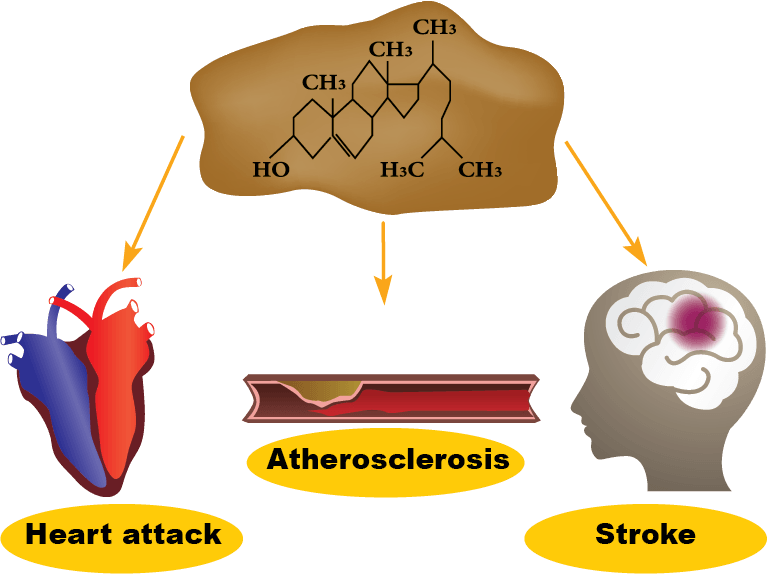 Stroke And Atherosclerosis Clipart (767x574), Png Download