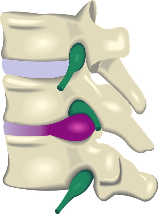 Disc Injury Herniation, Bulge, Protrusion Understanding - Protusiones Discales Clipart (531x720), Png Download