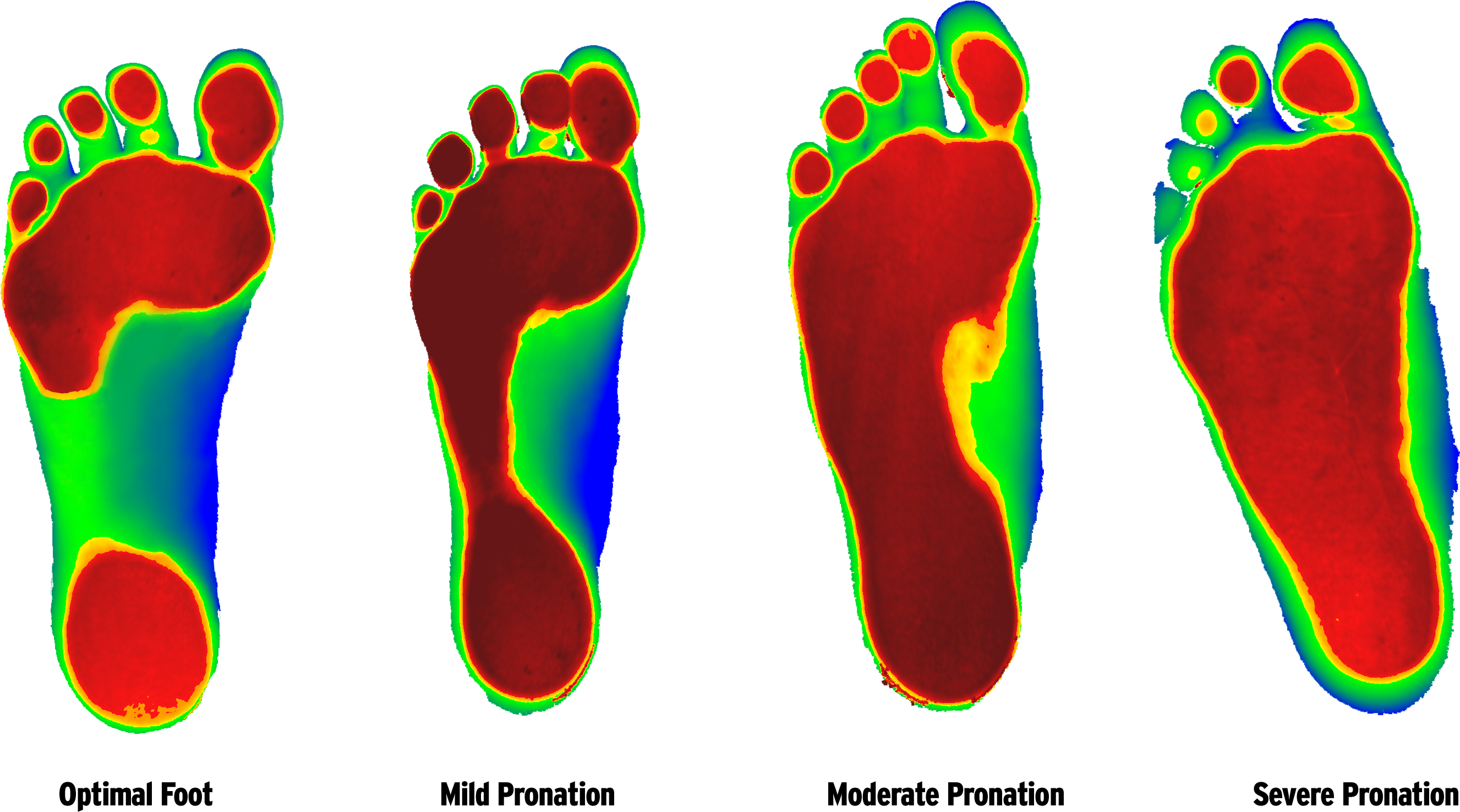 Foot Ranging From Least Severe To Most According To - Custom Orthotics Clipart (3072x1750), Png Download
