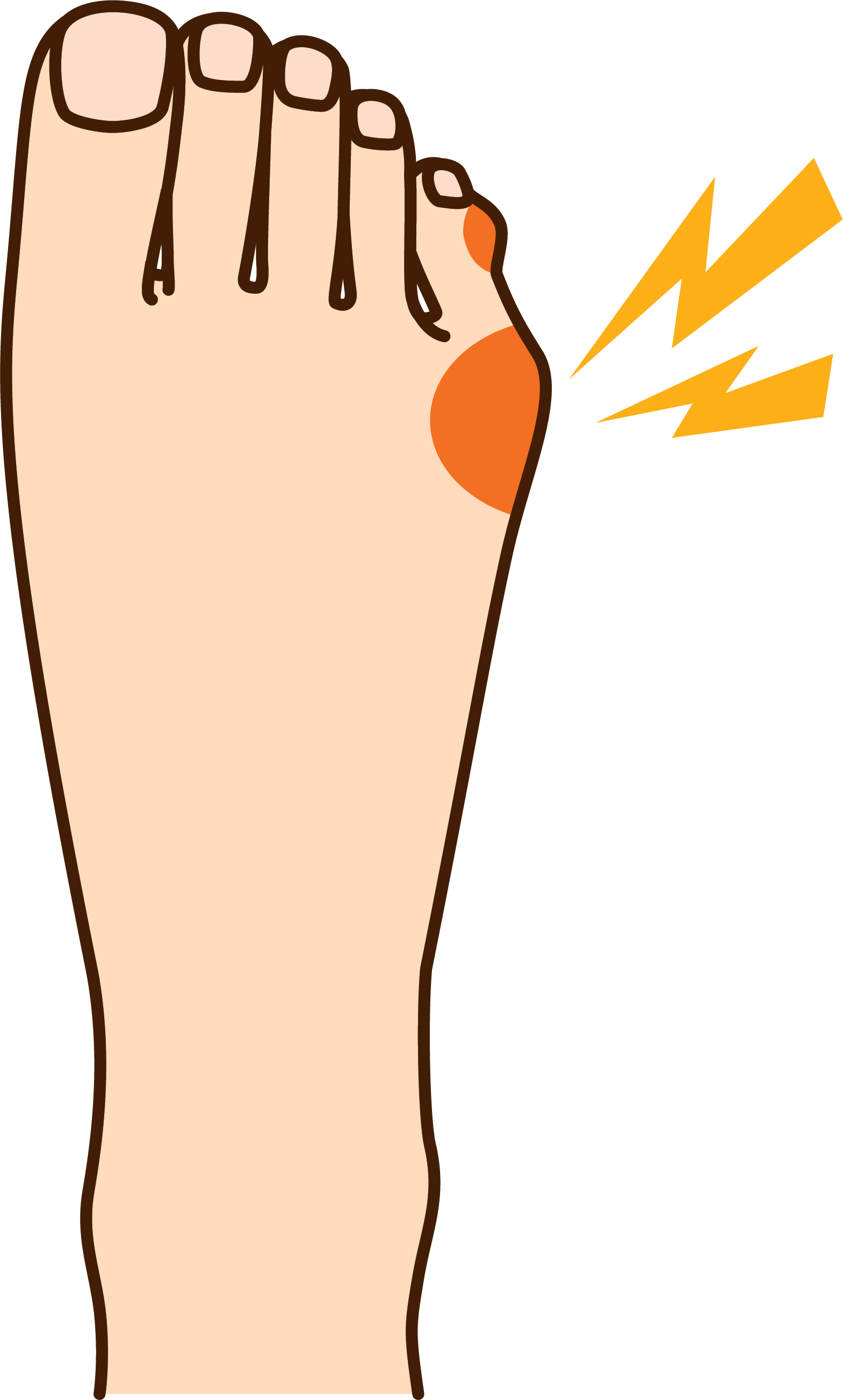 How To Relieve Your Tailor's Bunion Pain - Pinky Toe Bump Clipart (1569x2607), Png Download