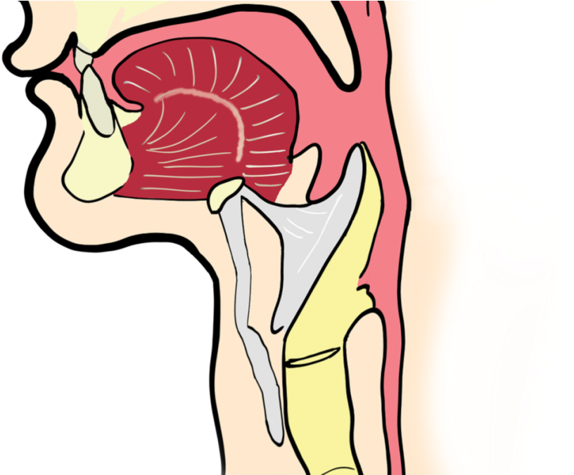 The Laryngeal Cancer Staging - Laringitis Png Clipart (1080x675), Png Download