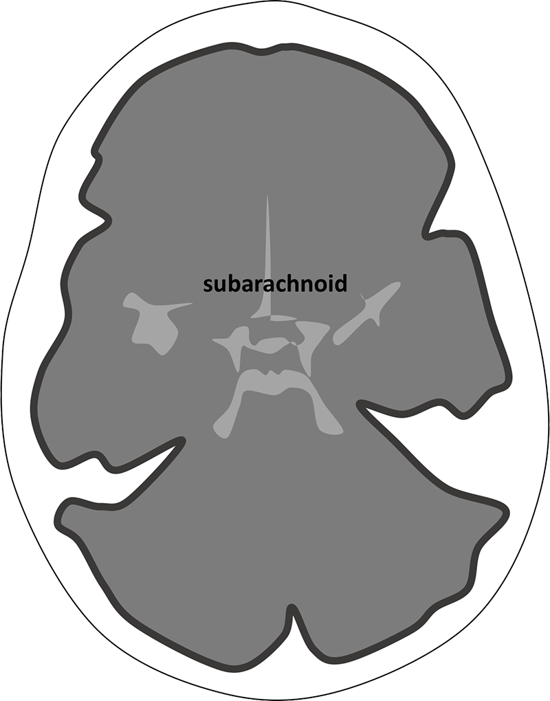 Diagram Showing The Appearance Of Subarachnoid Haemorrhage - Subarachnoid Hemorrhage Clipart (800x1020), Png Download