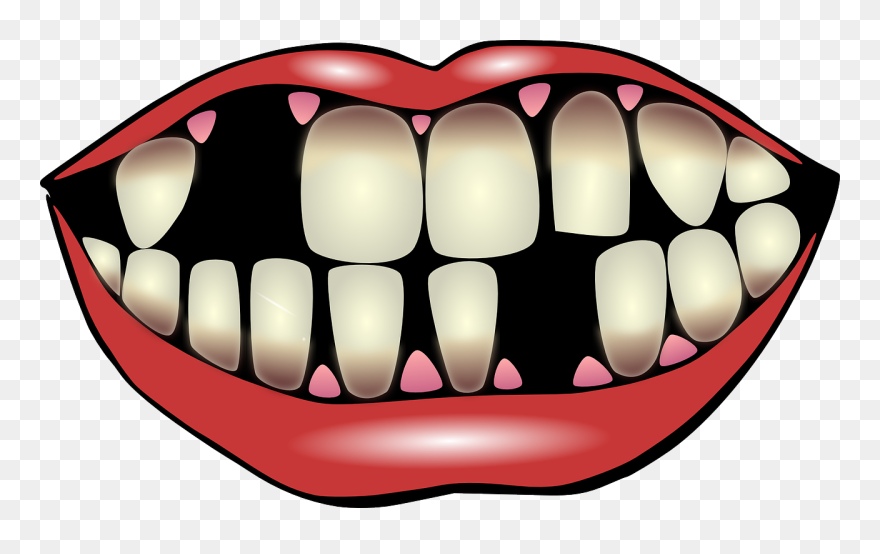 Kiss Clip Art - Tooth Decay Clipart - Png Download