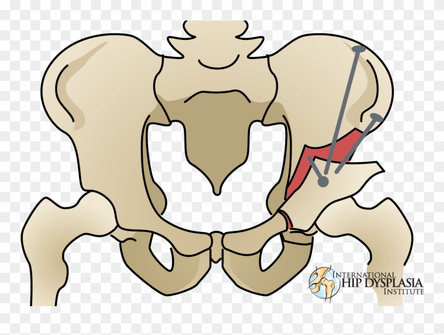 In The Meantime, Dr - Triple Pelvic Osteotomy Human Clipart