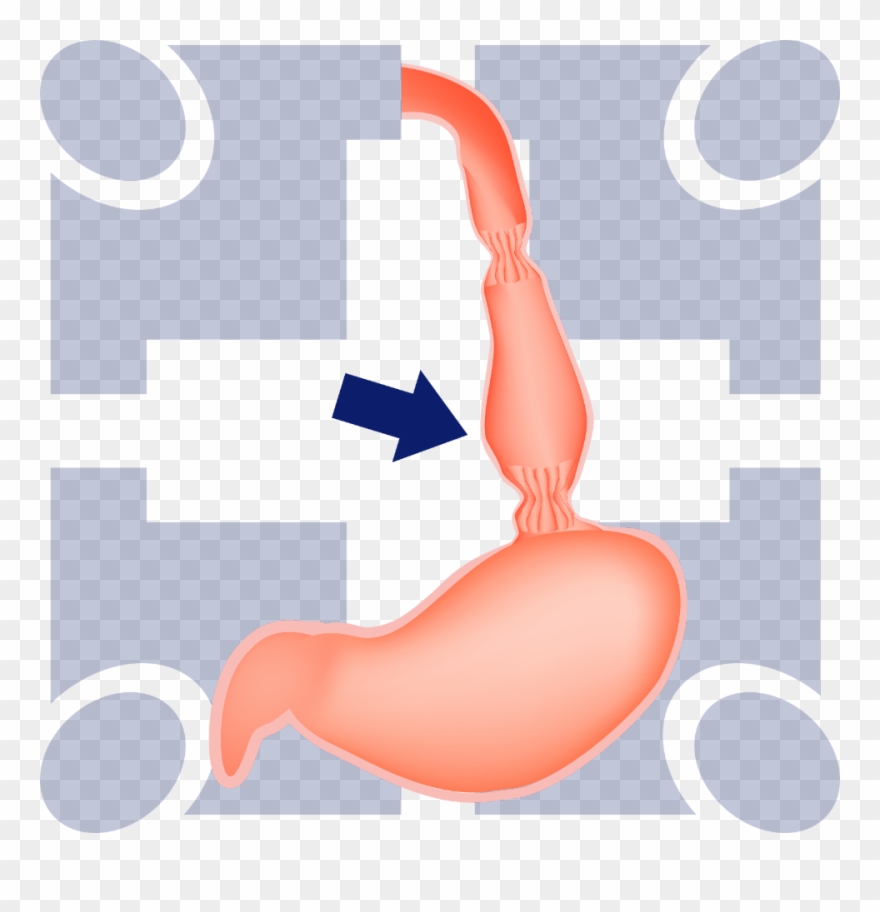 What Is Peroral Endoscopic Myotomy Clipart