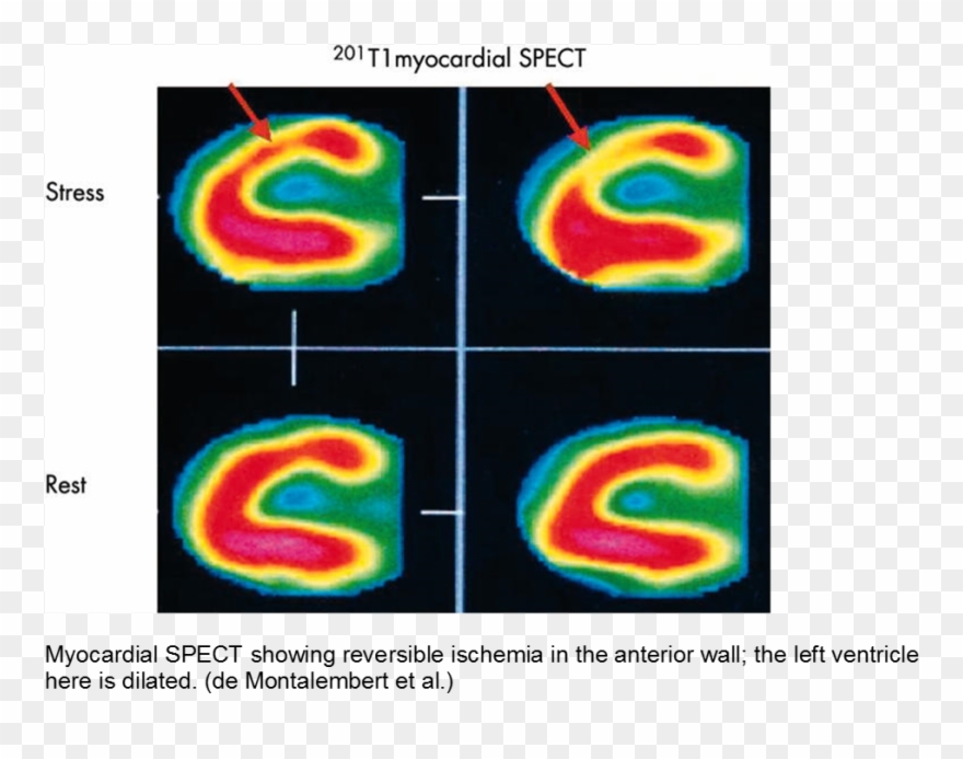 Evidence Of Myocardial Ischemia/infarction In Children - Ventricle Clipart