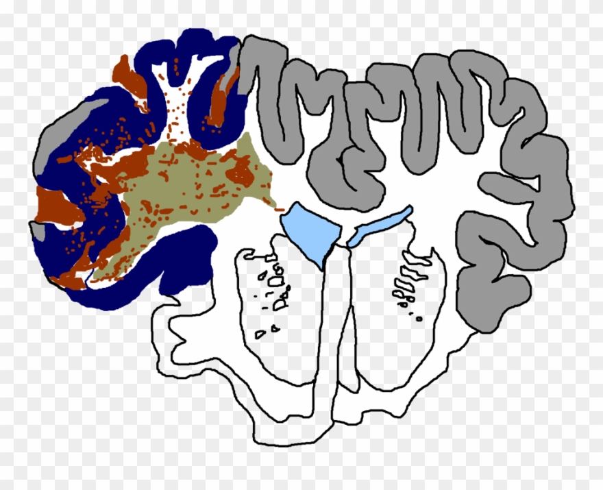 Traumatic Brain Injury Considered The Most Complex - Traumatic Brain Injury Clipart